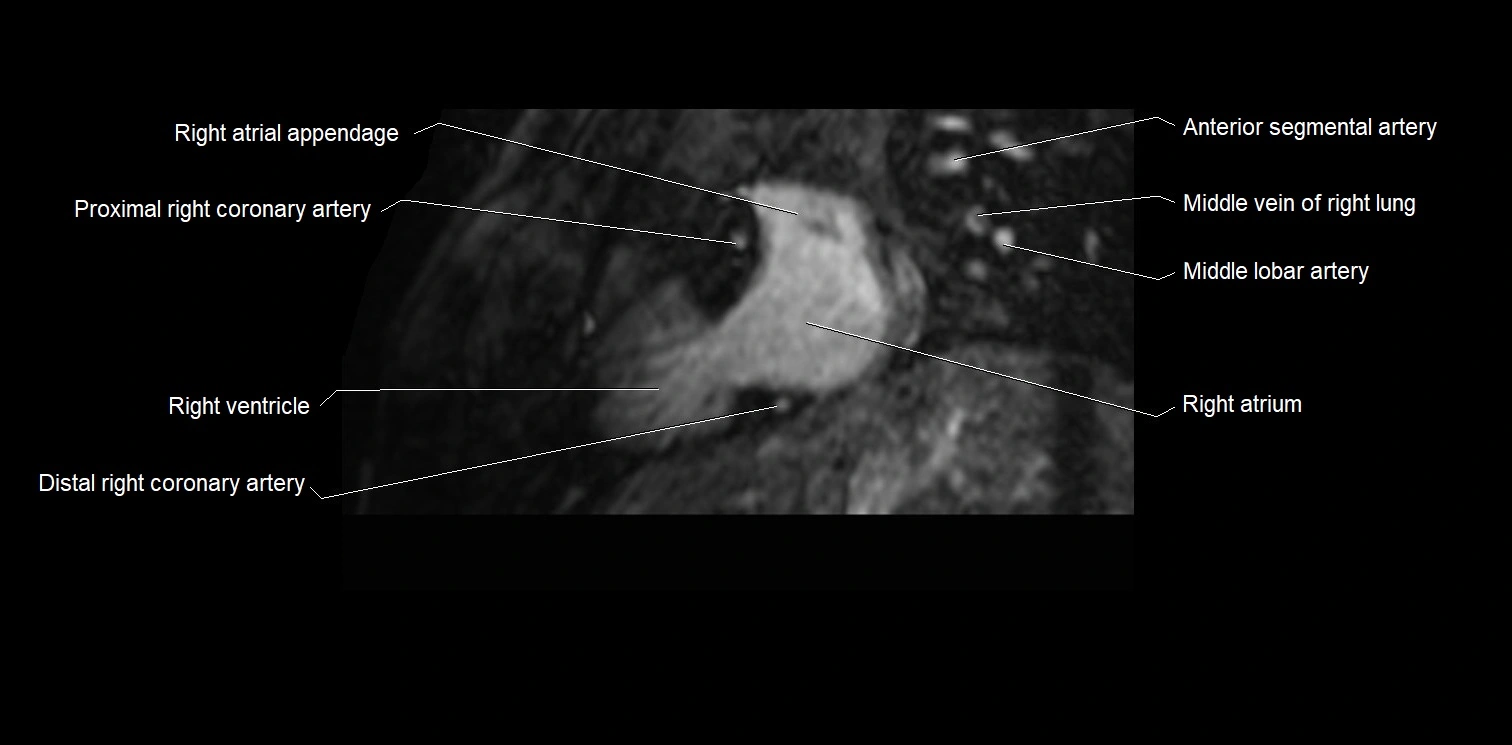 MRI heart and coronary arteries two chamber(sagittal)  anatomy image 7.webp